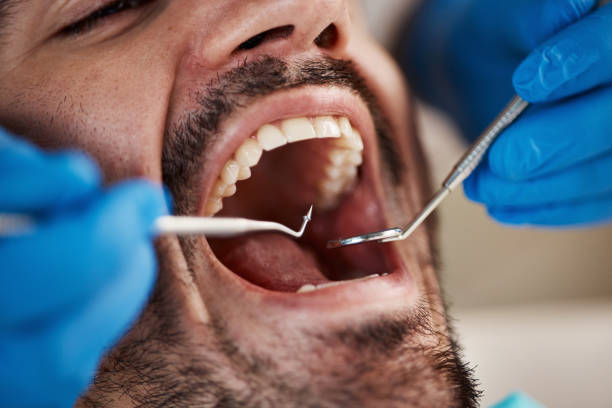 Best Emergency Dentist for Knocked-Out Tooth in Lead, SD